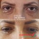 رفع سیاهی زیر چشم - کلینیک زیبایی دکتر سهیل ولی نژاد